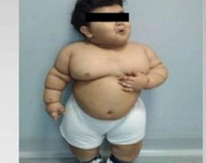 Bariatric-surgery-two-year-old.jpg