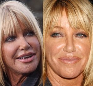 suzanne-somers-plastic-surgery-before-after.jpg