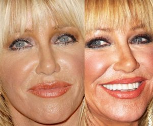 suzanne-somers-botox-fillers.jpg