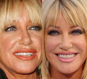 suzanne-somers-lip-implants.jpg