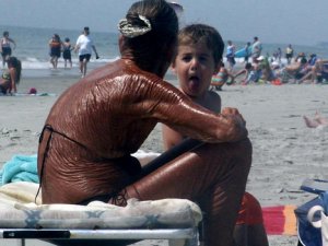 1333736498_sunburn.jpg