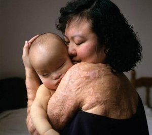 kim_phuc2.jpg
