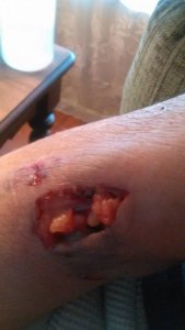 r-arm bite1.jpg r-arm bite1.jpg