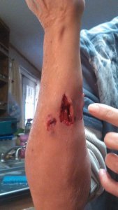 r-arm bite.jpg r-arm bite.jpg