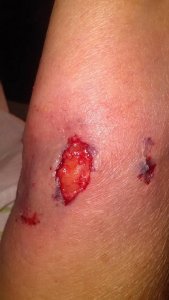 l-arm bite.jpg l-arm bite.jpg