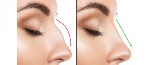 rhinoplasty-surgery-treatment-in-india.jpg