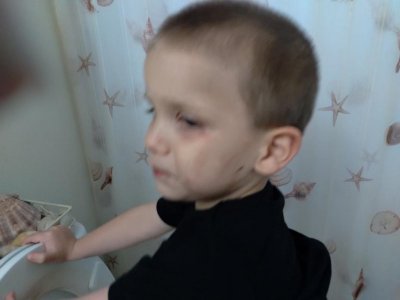 paxton face bruises, scratches 6-19-21.jpg