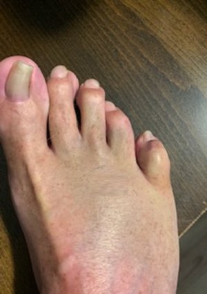 toe.jpg