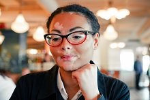 vitiligo-.jpg