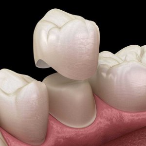 original_dental_crowns_hero_mobile_optimized.jpg