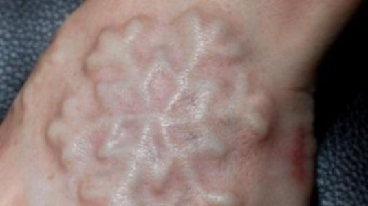 snowflake skin.jpg