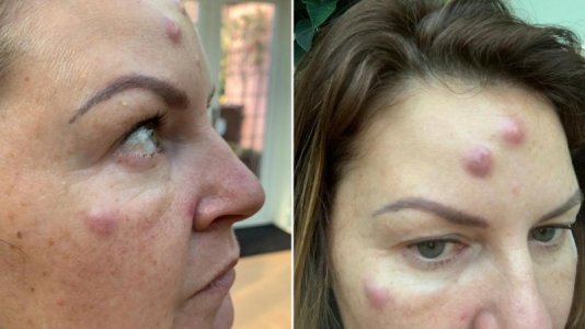 botox.jpg