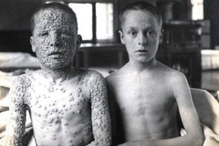 smallpox.jpg