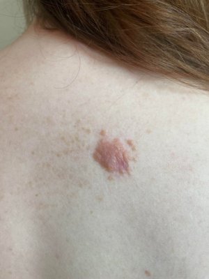 melanoma.jpg melanoma.jpg