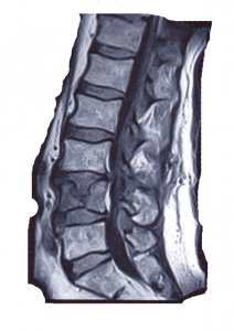Compression Fracture.jpg
