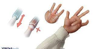 Trigger Finger (Stenosing Tenosynovitis)