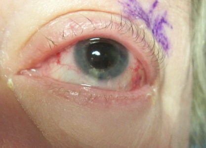 rd 2 eye1.jpg