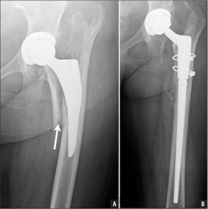 hip replacement 003.JPG
