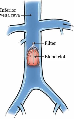 vena cava filter.JPG