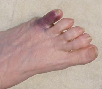toe.jpg toe.jpg