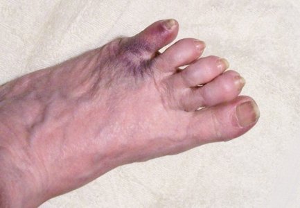 toe2.jpg toe2.jpg