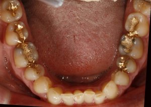 DENTURES.jpg