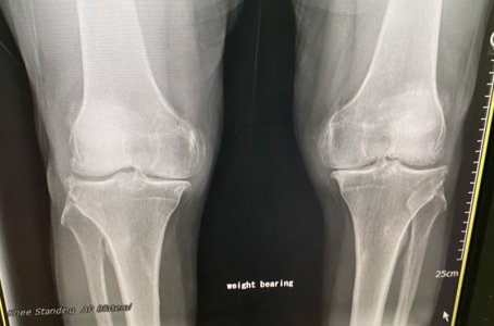 knees before.jpg