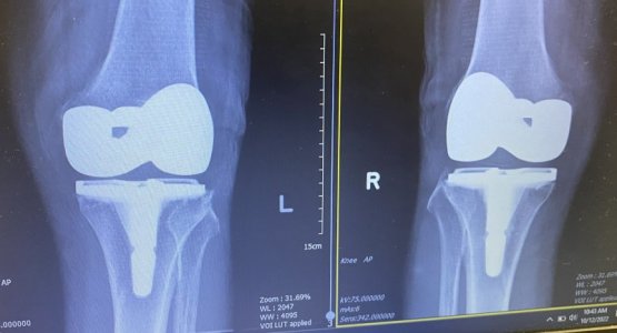 Knees after.jpg