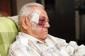 Senior Man With Injured Face And Black Eye Is Unhappy Stock Photo -  Download Image Now - iStock