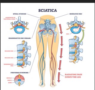 sciatica.jpg