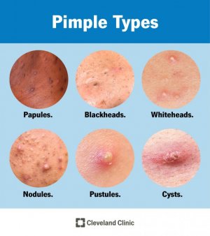 22468-pimples.jpg