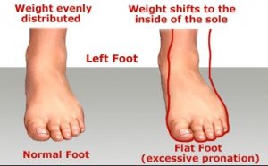 Flat-Feet-1.jpg Flat-Feet-1.jpg