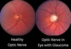 Glaucoma optic nerve..jpg