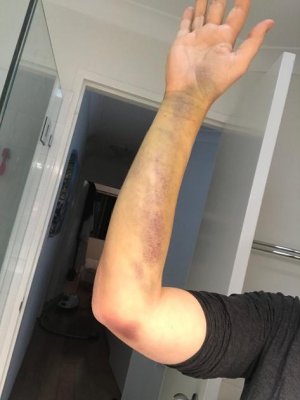 bruise.jpg bruise.jpg
