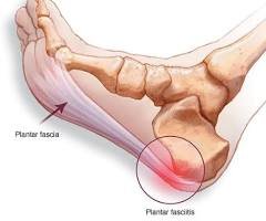 Cause of Plantar Fasciitis | Pivotal Motion Physiotherapy