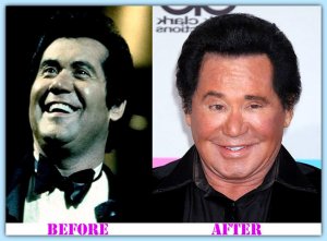 Wayne-Newton-Plastic-Surgery-before-and-after.jpg